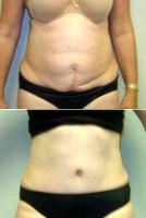 Tummy Tuck After C-section Before By Dr Andrew Jimerson, MD, Atlanta Plastic Surgeon