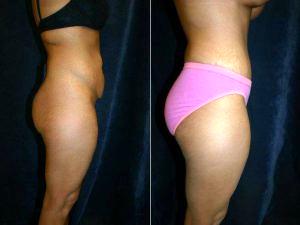 Tummy Tuck And Liposuction To Flanks By Dr. Joel Williams, MD, Dalton Plastic Surgeon