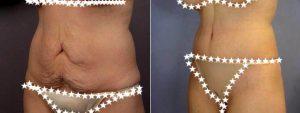Tummy Tuck By Doctor Grant Stevens, MD, Los Angeles Plastic Surgeon 856