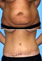 Tummy Tuck By Doctor Michael Leff, MD , Bellevue Plastic Surgeon