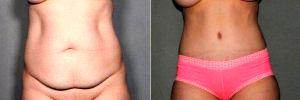 Tummy Tuck With Liposuction Flanks With Dr Larry C. Leverett, MD, FACS, Phoenix Plastic Surgeon