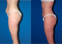 34-year-old Woman Treated With Abdominoplasty. Before With Doctor Eric Swanson, MD, Kansas City Plastic Surgeon