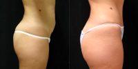 38 Year Old Woman Treated With Skin Only Tummy Tuck Before With Dr John S. Alspaugh, MD, FACS, Virginia Beach Plastic Surgeon