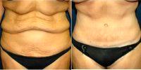 39 Year Old Woman Treated With Tummy Tuck Before With Doctor Mehdi K. Mazaheri, MD, Scottsdale Plastic Surgeon