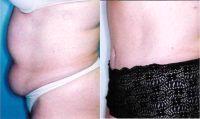 42 Year Old Female Before By Dr. Steven M. Lynch, MD, Albany Plastic Surgeon