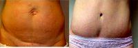 42 Year Old Woman Treated With Tummy Tuck Before By Doctor Samuel Shatkin, Jr., MD, Buffalo Plastic Surgeon