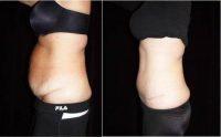 48 Year Old Woman Treated With Tummy Tuck Before By Doctor Leon Goldstein, MD, Madison Plastic Surgeon