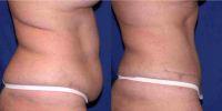 51 Year Old Woman Treated With Tummy Tuck Before By Dr. Richard Baxter, MD, Seattle Plastic Surgeon