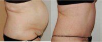 53 Year Old Woman Treated With Tummy Tuck Before By Doctor David P. Rapaport, MD, FACS, Manhattan Plastic Surgeon