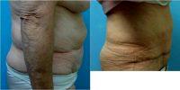 67 Year Old Woman Treated With Tummy Tuck Before With Dr. Roxanne Sylora, MD, Orlando Plastic Surgeon
