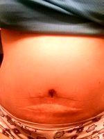 Abdominoplasty Recovery Image With Dr Austin Hayes, MD, Beaverton Plastic Surgeon