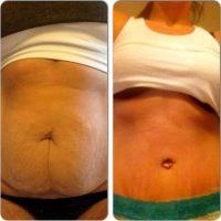 C Section Tummy Tuck By Dr. Jeffrey Rockmore, MD, Albany Plastic Surgeon