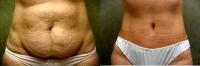 C.L.A.S.S  Tummy Tuck Before By Dr. Frank Campanile, MD, Denver Plastic Surgeon
