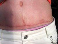 Columbus Cosmetic Stomach Surgery
