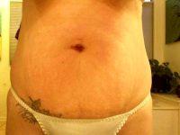 Cosmetic Surgery Tummy Tuck With Dr. Brent Moelleken, MD, Beverly Hills Plastic Surgeon
