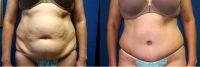 Doctor Aaron J. Mayberry, MD, FACS, Albuquerque Plastic Surgeon - 51 Year Old Woman Treated With Tummy Tuck Before