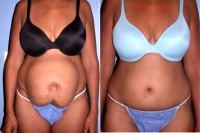 Doctor James Anthony, MD, San Francisco Plastic Surgeon - 42 Year Old Woman Treated With Tummy Tuck