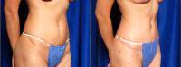 Doctor Jules Walters, MD, New Orleans Plastic Surgeon - 45 Year Old Woman Treated With Tummy Tuck