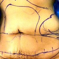 Doctor Keith Hodge, MD, Leawood Plastic Surgeon Plastic Surgery Abdominal Pic