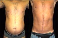 Doctor Leon Goldstein, MD, Madison Plastic Surgeon - 48 Year Old Man Treated With Tummy Tuck