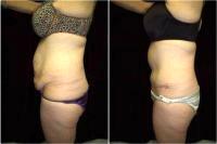Doctor Leon Goldstein, MD, Madison Plastic Surgeon - 51 Year Old Woman Treated With Tummy Tuck