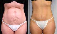 Doctor Michael J. Denk, MD, Virginia Beach Plastic Surgeon - 44 Year Old Woman Treated With Tummy Tuck