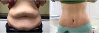 Doctor William Andrade, MD, Toronto Plastic Surgeon - 37 Year Old Woman Treated With Tummy Tuck
