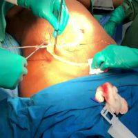 Doctor William Barber, MD, Greensboro Plastic Surgeon The Tummy Tuck Photo
