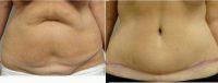 Dr Anne Taylor, MD, Columbus Plastic Surgeon - 44 Year Old Woman Treated With Tummy Tuck