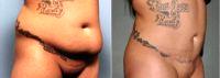 Dr Barry L. Eppley, MD, DMD, Indianapolis Plastic Surgeon - 38 Year Old Woman Treated With Tummy Tuck Before