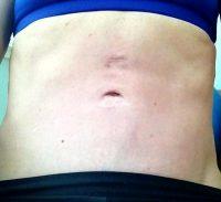 Dr Charles Zollman, MD, Indianapolis Plastic Surgeon Brazilian Tummy Tuck Candidate