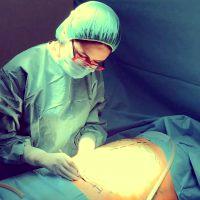 Dr Eric Swanson, MD, Leawood Plastic Surgeon Post Tummy Tuck
