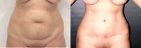 Dr Pedro A. Cota, MD, Mexico Plastic Surgeon - 40 Year Old Woman Treated With Tummy Tuck