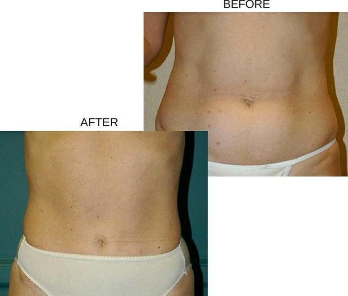overweight plus size tummy tuck