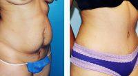 Dr Vincent A. Naman, MD, Columbus Plastic Surgeon Tummy Tuck After Results
