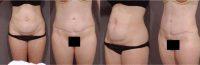 Dr William Koenig, MD, Rochester Plastic Surgeon - 38 Year Old Woman Treated With Tummy Tuck
