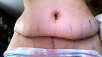 Dr Yngvar A. Hvistendahl, MD, San Francisco Plastic Surgeon Tummy Tuck After Weight Loss Photo