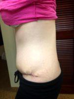 Dr. David B. Reath, MD, Knoxville Plastic Surgeon Tummy Tuck After C Section Results