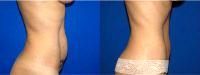 Dr. Farbod Esmailian, MD, Orange County Plastic Surgeon - 37 Year Old Treated With Tummy Tuck