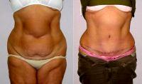 Dr. Guy D. Sterne, MD, Birmingham Plastic Surgeon - 59 Year Old Woman Treated With Tummy Tuck