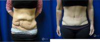 Dr. Jamie Moenster, DO, Tucson Plastic Surgeon - 46 Year Old Woman Treated With Tummy Tuck
