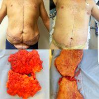 Dr. Jason E. Leedy, MD, Cleveland Plastic Surgeon Tummy Tuck Weight Loss