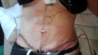 Dr. Larry Fan, MD, San Francisco Plastic Surgeon Tummy Procedures Image