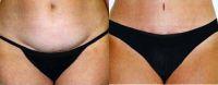 Dr. Mary Ann Contogiannis, MD, Greensboro Plastic Surgeon - Female The Best Tummy Tuck