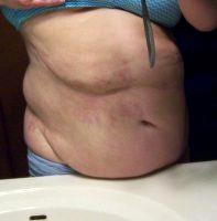 Dr. Richard Baxter, MD, Seattle Plastic Surgeon Belly Surgery Results