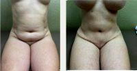 Dr. S. Larry Schlesinger, MD, FACS, Honolulu Plastic Surgeon - 40 Year Old Woman Treated With _Ultimate Silhouette-Plasty_ Before