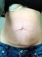 Dr. Steven M. Lynch, MD, Albany Plastic Surgeon Modified Tummy Tuck Results
