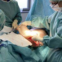 Endoscopic Tummy Tuck Candidate By Doctor Kenton Schoonover, MD, Wichita Plastic Surgeon