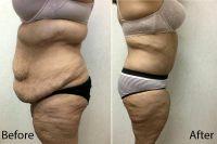 Liposuction & Tummy Tuck Photo By Doctor Dallas Buchanan, MD, Tampa Plastic Surgeon