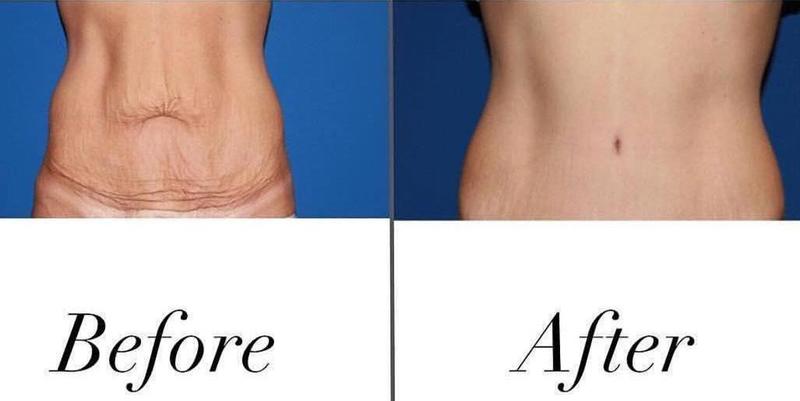 mini tummy tuck before and after images